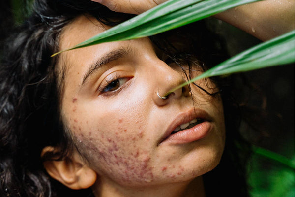 cbd et acne peau